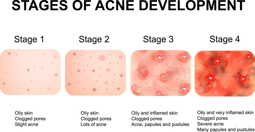 Types of acne and its treatment